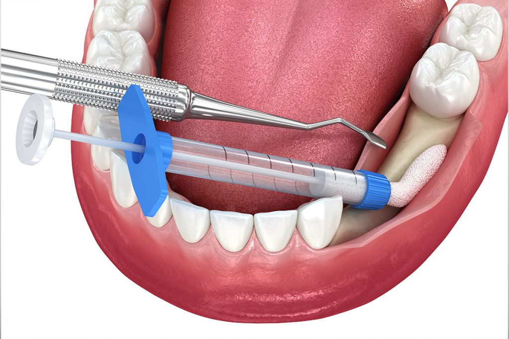 How Much Does Bone Grafting Cost in Bedford, NH