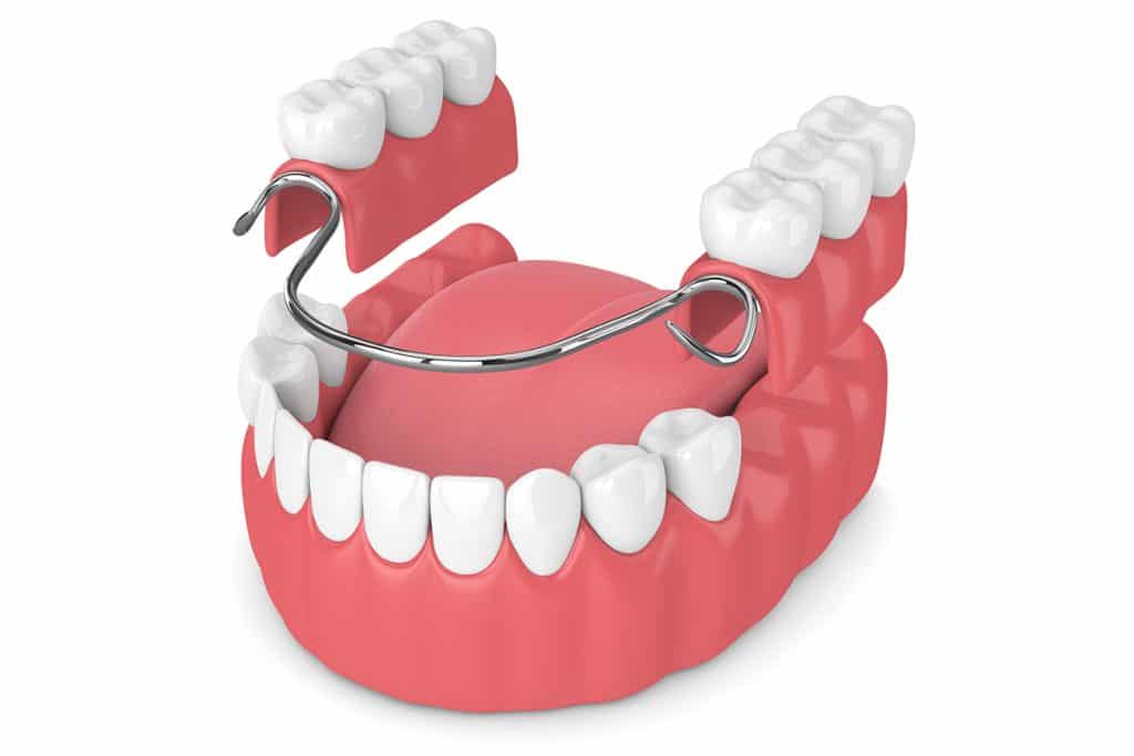 How Much Do Implant-Supported Dentures Cost in Bedford, NH?